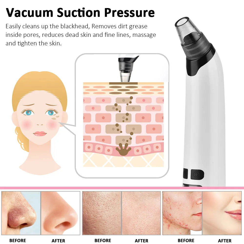 Facial Cleaner Nose Blackhead Remover Pimple